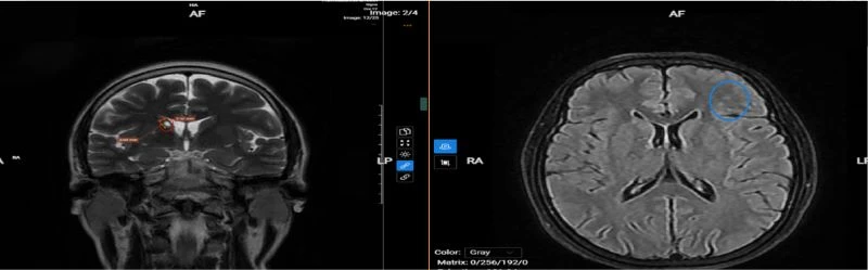 Atherosclerosis Frequently Affects Vietnamese People Due to a Common Critical Error