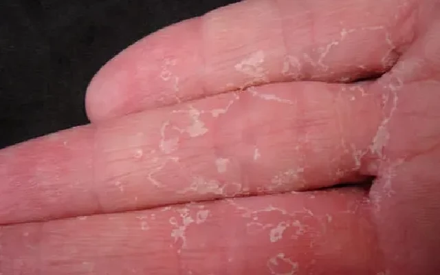 Why does the hand peel off when changing seasons?