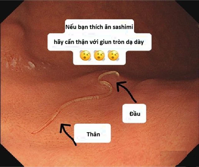 The man suddenly had abdominal pain, laparoscopy, goosebumps discovered the 5cm long "wriggled" inside