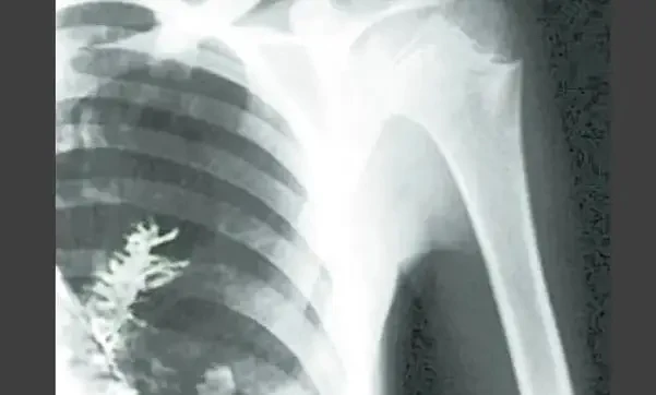 Russian engineers were diagnosed with lung cancer, when surgery, tumor was discovered one thing
