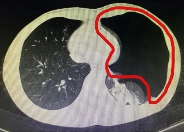 The 25 -year -old boy had a puncture of the lungs, knew the cause, the doctor was bored: How did it be strong!?