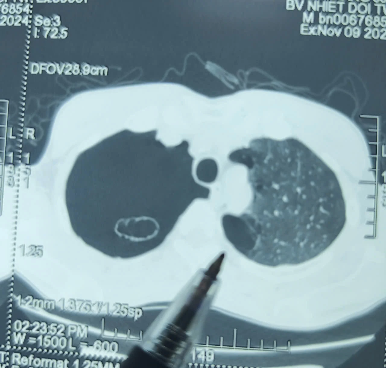 The man in Hanoi was admitted to the emergency room, discovered that the lungs had punctured: the doctor pointed out the cause