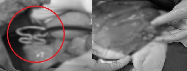 The female patient has a small intestine because of a 'lost' in her body for 30 years