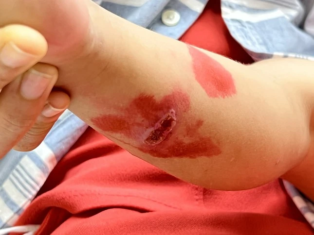 Parents heal themselves, many children are hospitalized because they get worse