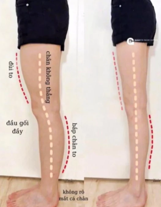 Exercise improving the condition of puffing up, bent legs: Cham practice every day, women have straight legs, avoid osteoarthritis