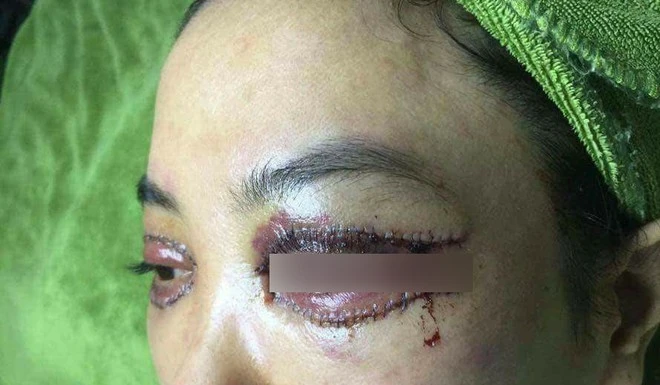 The cosmetic doctor talks about the "eyelid surgery causing storm": may be swollen and red after the procedure, but about the beauty is broken