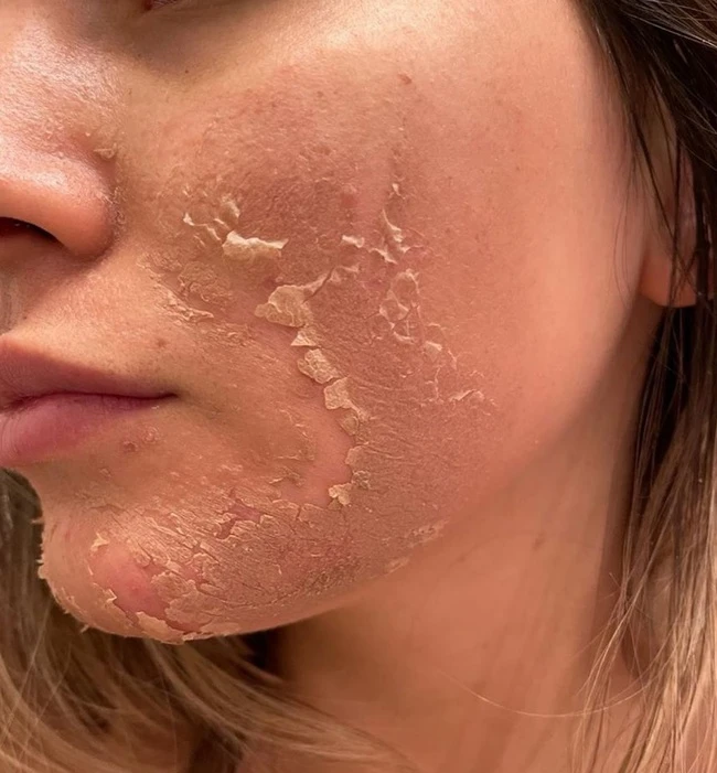 Experts point out 3 essential steps to do immediately to beautiful skin and prevent melasma