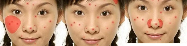 Revealing to you the process of acne formation