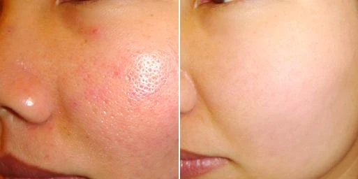 Large pores, how to take care of how to shrink