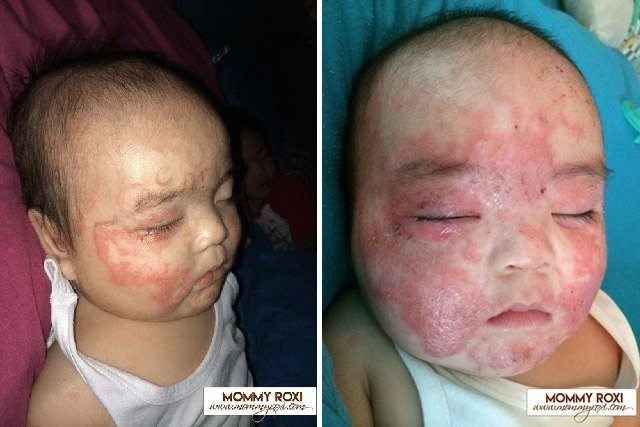 The 3 -year journey of the boy's 3 -year treatment of eczema from 3 months of age