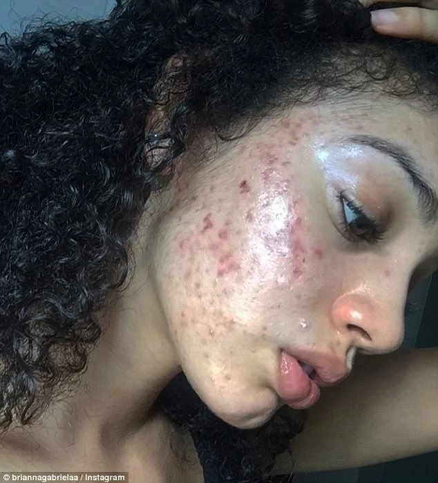 Her face was crushed because of acne, the girl suddenly became alcohol on the internet after sharing how to treat acne "as easy to eat candy"