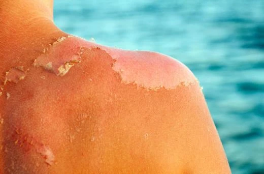 6 skin problems when hot and tips to recover