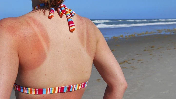 The most effective way to treat sunburned skin at home