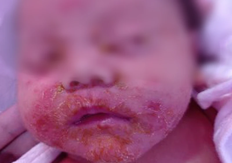 Precautions when children have staphylococcal scales syndrome