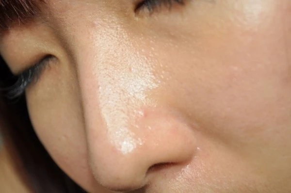 Oily skin but lack of moisture causing large pores and raging acne: Want to fix this 3 steps