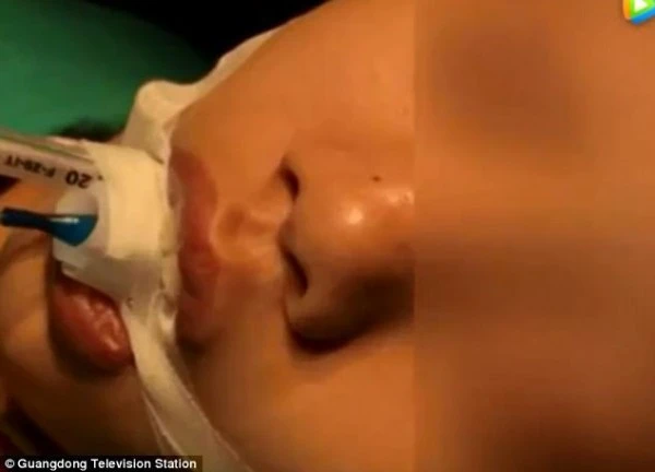 The girl almost lost her life because she squeezed acne, and this is the reason why you absolutely should avoid touching the "triangle zone"