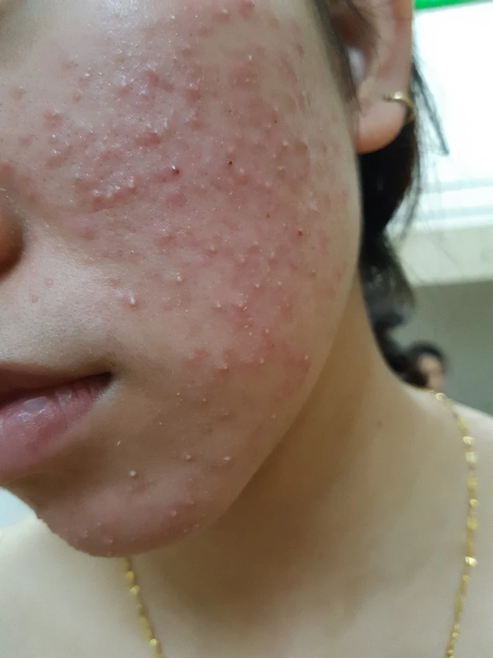 Acne needle roller: Dermatologist recommends important notes before doing