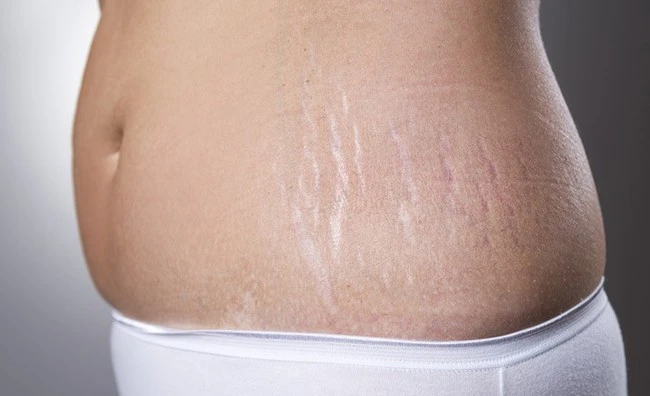 Pregnant women will not have to watch the worries of stretch marks with these 5 bottles of oil