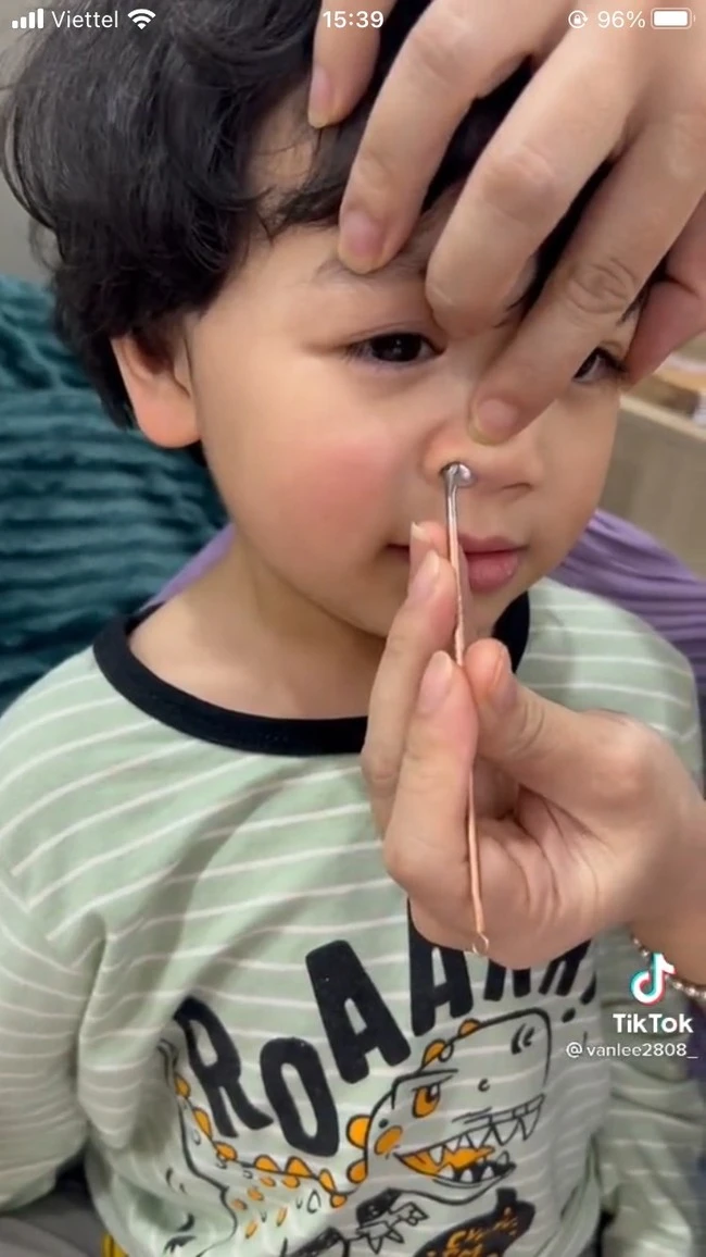 Naughty makeup babies with pearls caught in the nose, the mother's treatment has helped her child escape from danger quickly