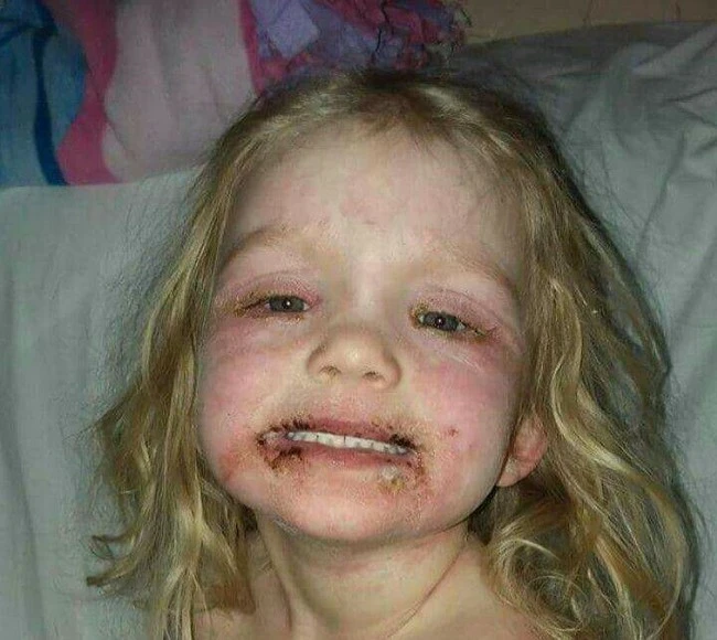 "Don't arbitrarily makeup for your child anymore", the call of a mother with a daughter blistered all over her body due to allergies to cheap cosmetics