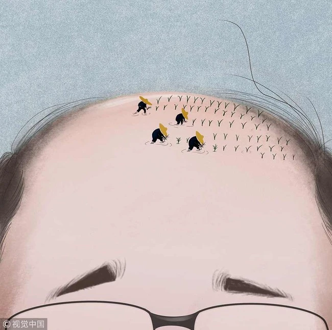 "Pandemic" bald attacks Chinese men, hair care and transplanting services grow like mushrooms after rain