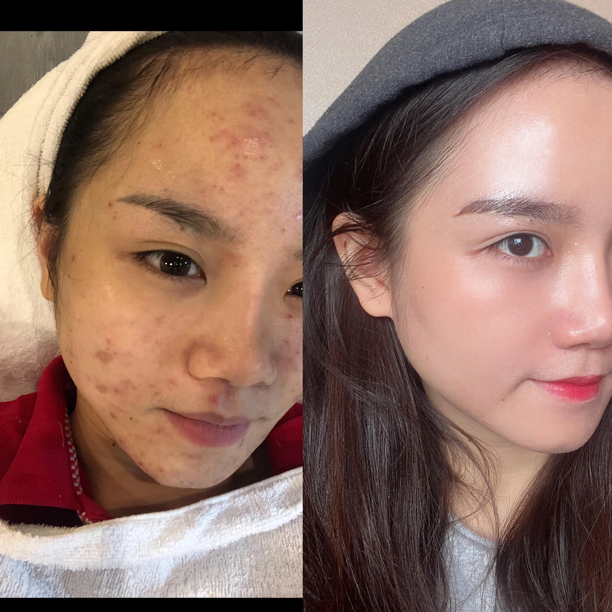 Over the bad skin period, this girl had a reform in the way of care and aging by applying sunscreen like no one like anyone else.
