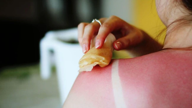 Blesules due to sunburn: There is a very wrong type of handling but many people still do