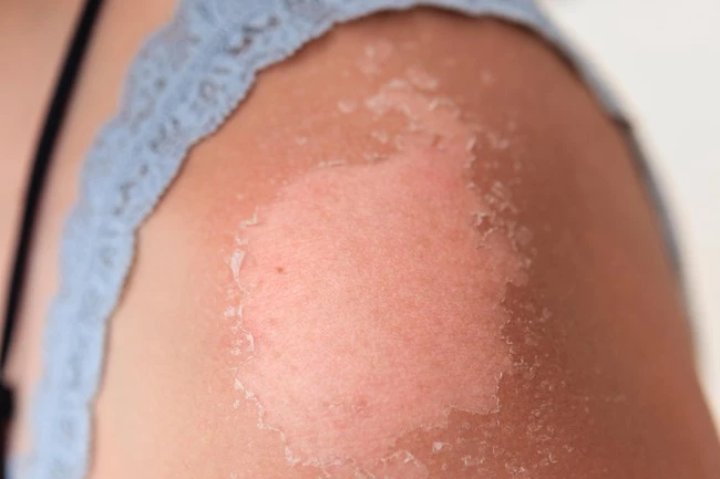 How long can sunburn on the skin and measures to soothe the sun, restore the skin faster