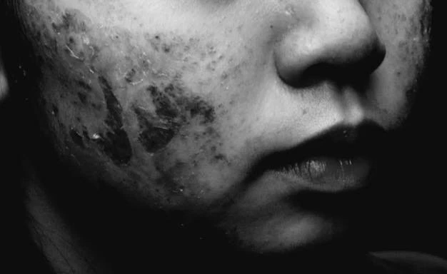 The danger from the skin peel method