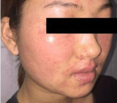 Facial care in these ways, many women cry because the skin is crusted, rough and hard to recover
