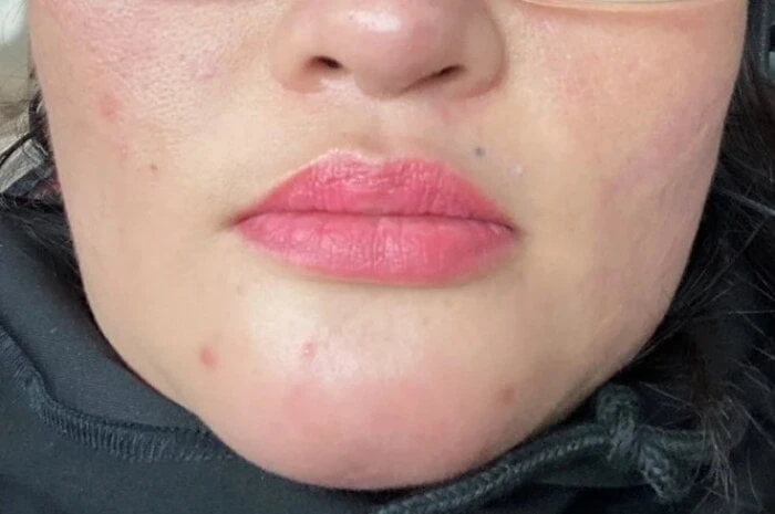 Injecting filler to beautify the chin, the woman has pus in her mouth
