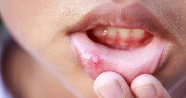 Signs in the mouth of cancer warning: Whoever hurts more than 1 month to see a doctor right away, do not leave it late