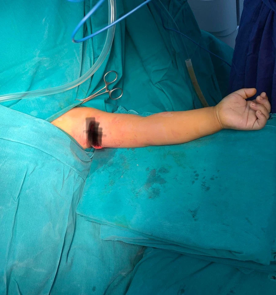 The 2 -year -old boy was broken from the movement nerve of his hand due to falling when holding a glass of glass