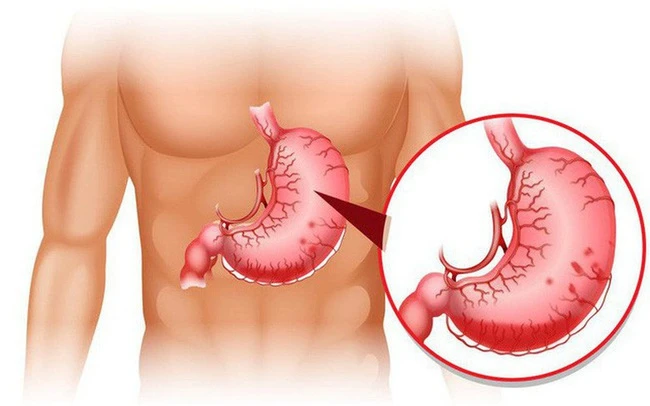 How to avoid stomach pain broke out on Tet holiday?