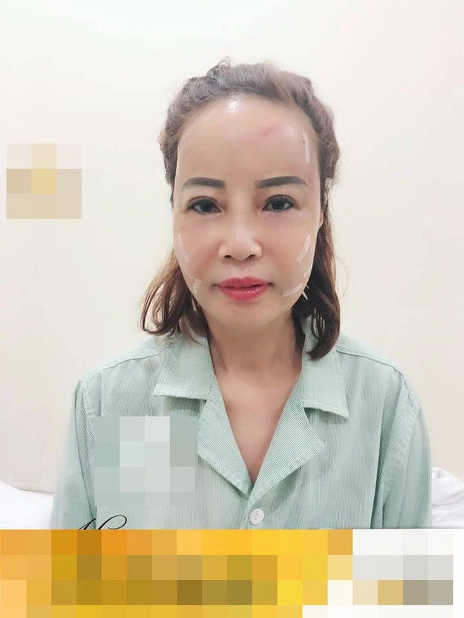 After taking the young husband to press the eyelids, the 62 -year -old bride was shocked with the "20 -year -old child" face thanks to PTTM