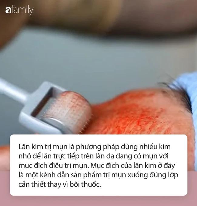 Needle Roller Beauty at the end of the year: Specialist of the province must carefully learn the solution and needle roller