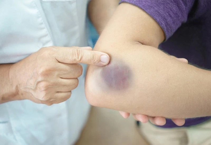 Actor Chau Hai My died, his body was full of bruises: What is the reason for bruises?